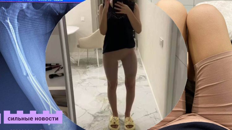 «Я слышала, как мне пилили кость, доставали старую металлоконструкцию, сверлили, били молотком» – история гомельчанки, которая не сдалась после тяжелой аварии и научилась ходить третий раз в 18 лет